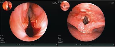 Severe Refractory Paraneoplastic Mucous Membrane Pemphigoid Successfully Treated With Rituximab